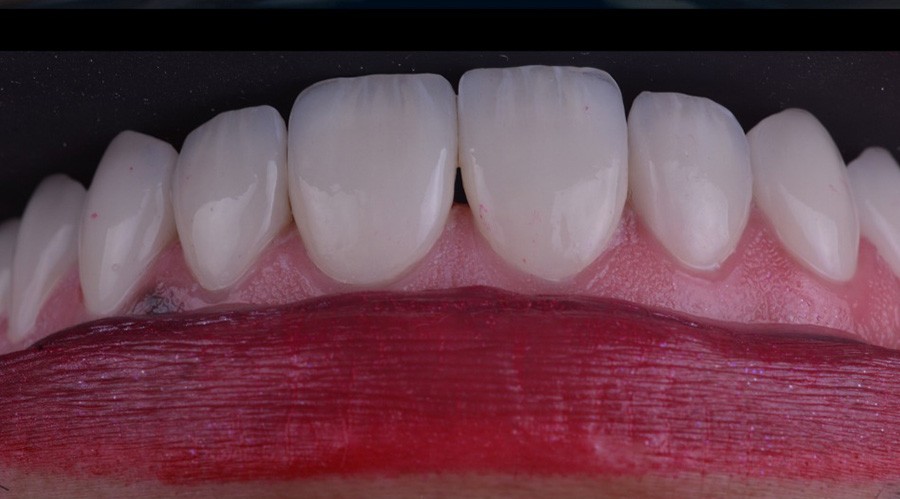 قبل تركيبات-اسنان